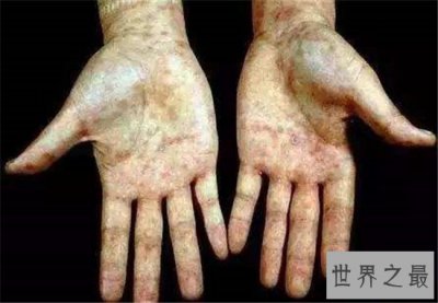 ​世界上最危险的10种细菌，梅毒高居榜首！